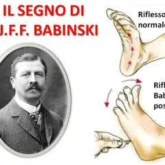 Ritratto di J.J.F. Babinski accanto a illustrazioni che mostrano il riflesso normale e il riflesso di Babinski positivo.