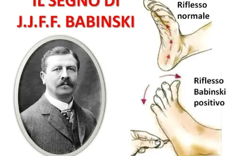 Ritratto di J.J.F. Babinski accanto a illustrazioni che mostrano il riflesso normale e il riflesso di Babinski positivo.