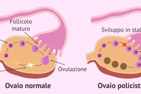 Confronto tra ovaio normale e ovaio policistico. Il secondo mostra follicoli immaturi multipli e sviluppo in stallo, indicando la necessità di una cura per l'ovaio policistico.