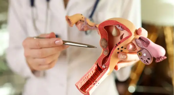 Modello anatomico dell'utero e delle ovaie, con evidenziate le perdite ad albume d'uovo.