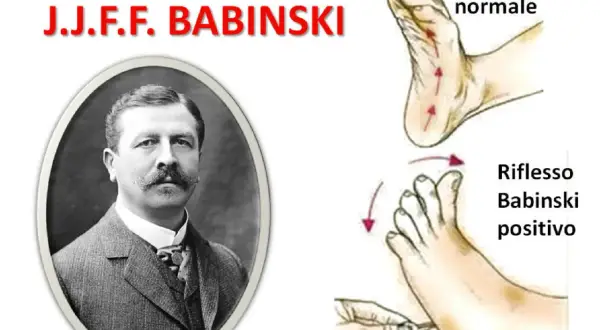 Ritratto di J.J.F. Babinski accanto a illustrazioni che mostrano il riflesso normale e il riflesso di Babinski positivo.