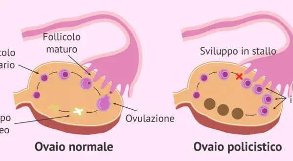 Confronto tra ovaio normale e ovaio policistico. Il secondo mostra follicoli immaturi multipli e sviluppo in stallo, indicando la necessità di una cura per l'ovaio policistico.