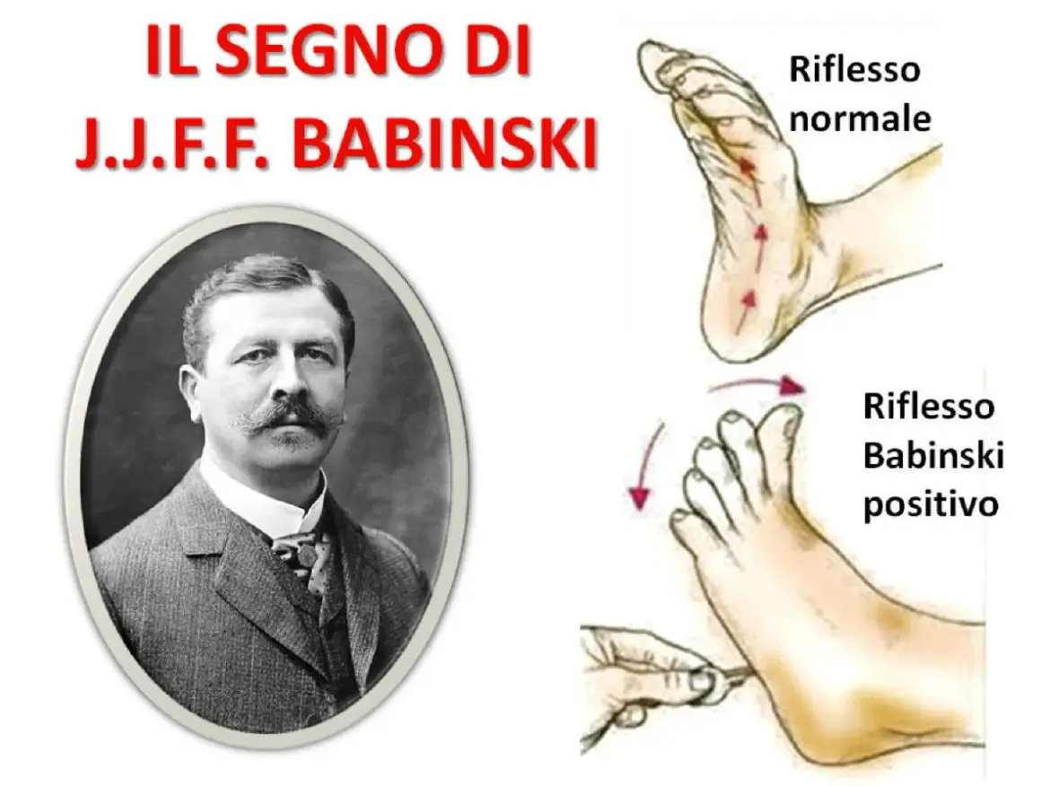 Ritratto di J.J.F. Babinski accanto a illustrazioni che mostrano il riflesso normale e il riflesso di Babinski positivo.
