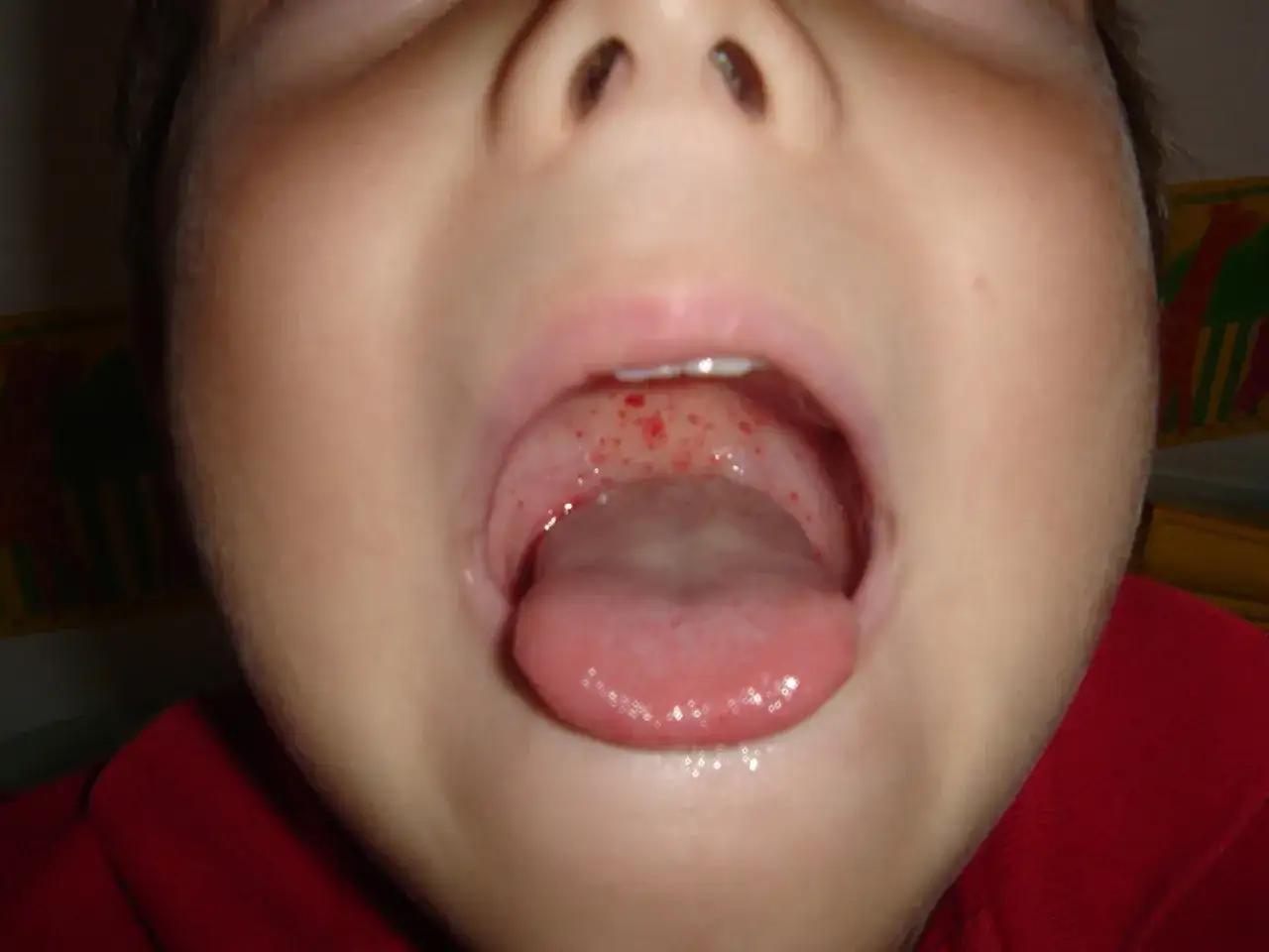 Bocca di bambino con puntini rossi sulla lingua e sul palato, possibili sintomi streptococco bambini.