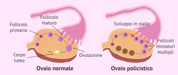 Confronto tra ovaio normale e ovaio policistico. Il secondo mostra follicoli immaturi multipli e sviluppo in stallo, indicando la necessità di una cura per l'ovaio policistico.